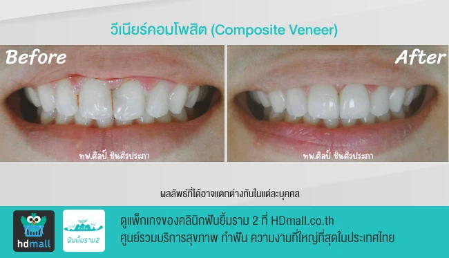 รีวิวทำวีเนียร์ ที่ คลินิกฟันยิ้มรามสอง รูปที่ 4