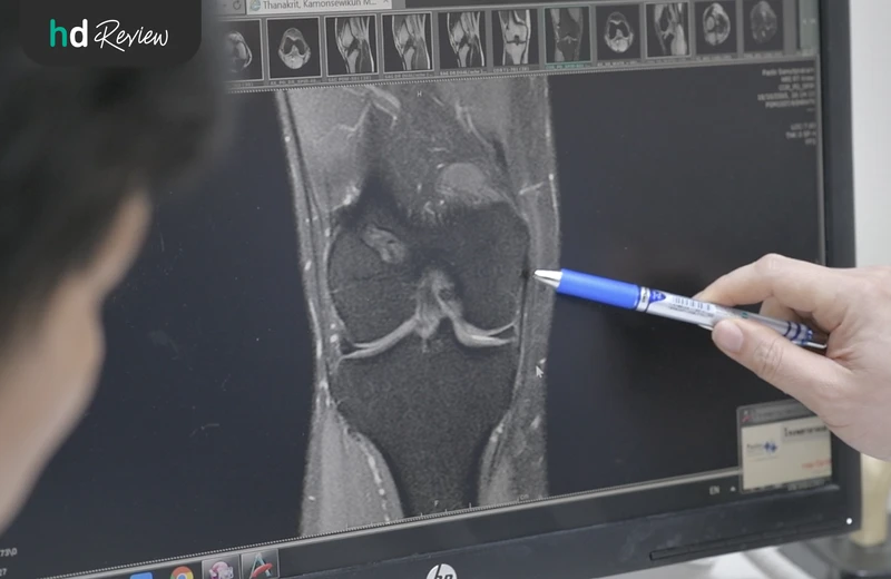 ผลการตรวจ MRI เข่า