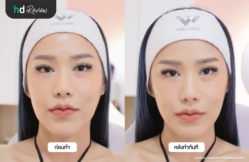 ภาพเปรียบเทียบก่อนและหลังทำ Facelift ยกกระชับกรอบหน้า