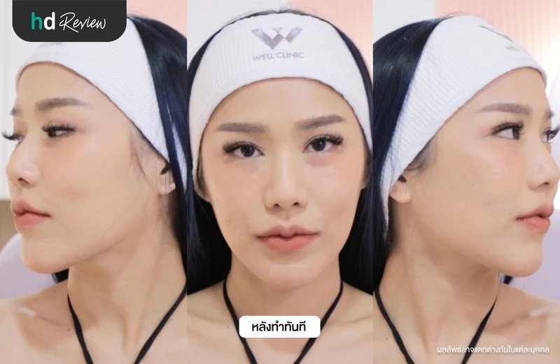 ภาพหลังทำ Facelift ยกกระชับกรอบหน้าทันที