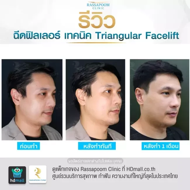 รีวิว Triangular Facelift ที่ Rassapoom Clinic (รัสมิ์ภูมิคลินิก) รูป 2