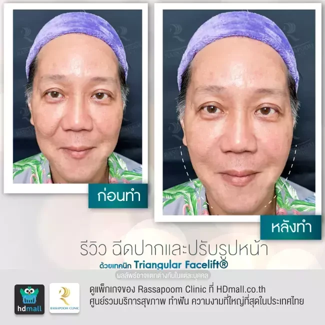 รีวิว Triangular Facelift ที่ Rassapoom Clinic (รัสมิ์ภูมิคลินิก) รูป 3