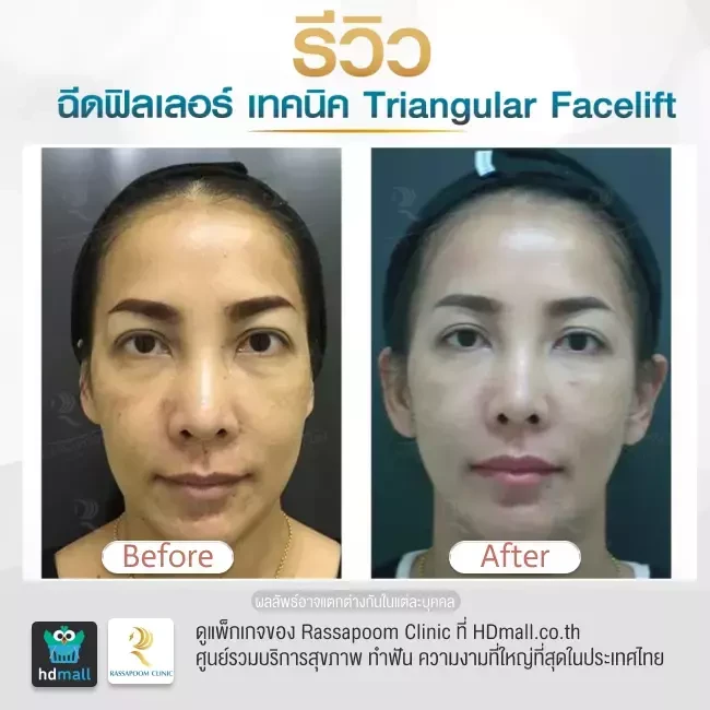 รีวิว Triangular Facelift ที่ Rassapoom Clinic (รัสมิ์ภูมิคลินิก) รูป 4