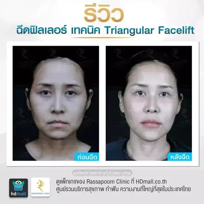 รีวิว Triangular Facelift ที่ Rassapoom Clinic (รัสมิ์ภูมิคลินิก) รูป 5