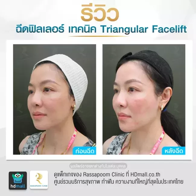 รีวิว Triangular Facelift ที่ Rassapoom Clinic (รัสมิ์ภูมิคลินิก) รูป 6