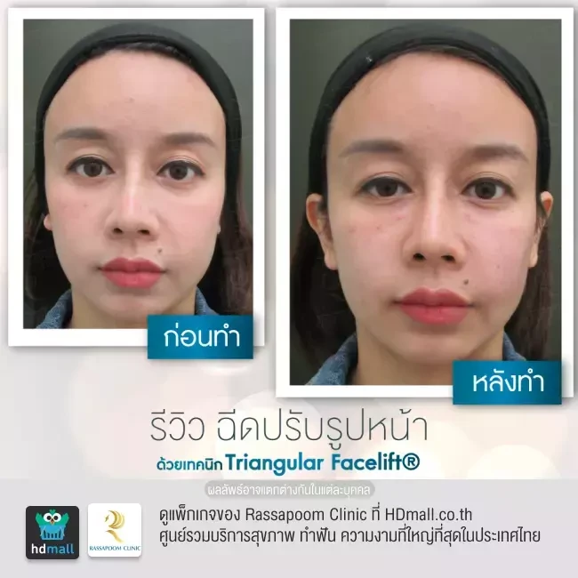 รีวิว Triangular Facelift ที่ Rassapoom Clinic (รัสมิ์ภูมิคลินิก) รูป 7