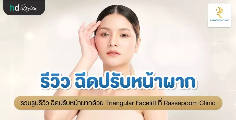 รีวิว ฉีดปรับหน้าผากด้วย Triangular Facelift ที่ Rassapoom Clinic