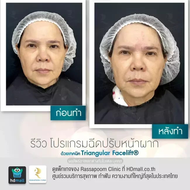 รีวิว ฉีดปรับหน้าผากด้วย Triangular Facelift ที่ Rassapoom Clinic (รัสมิ์ภูมิคลินิก) รูปที่ 1