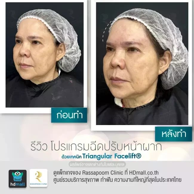 รีวิว ฉีดปรับหน้าผากด้วย Triangular Facelift ที่ Rassapoom Clinic (รัสมิ์ภูมิคลินิก) รูปที่ 2