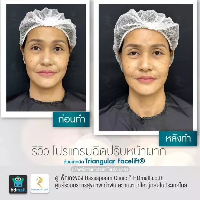 รีวิว ฉีดปรับหน้าผากด้วย Triangular Facelift ที่ Rassapoom Clinic (รัสมิ์ภูมิคลินิก) รูปที่ 3