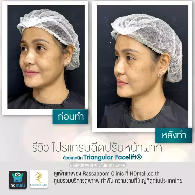 รีวิว ฉีดปรับหน้าผากด้วย Triangular Facelift ที่ Rassapoom Clinic (รัสมิ์ภูมิคลินิก) รูปที่ 4