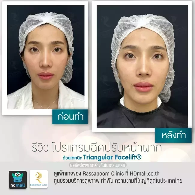 รีวิว ฉีดปรับหน้าผากด้วย Triangular Facelift ที่ Rassapoom Clinic (รัสมิ์ภูมิคลินิก) รูปที่ 5