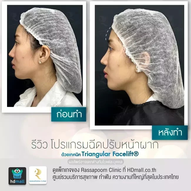 รีวิว ฉีดปรับหน้าผากด้วย Triangular Facelift ที่ Rassapoom Clinic (รัสมิ์ภูมิคลินิก) รูปที่ 6