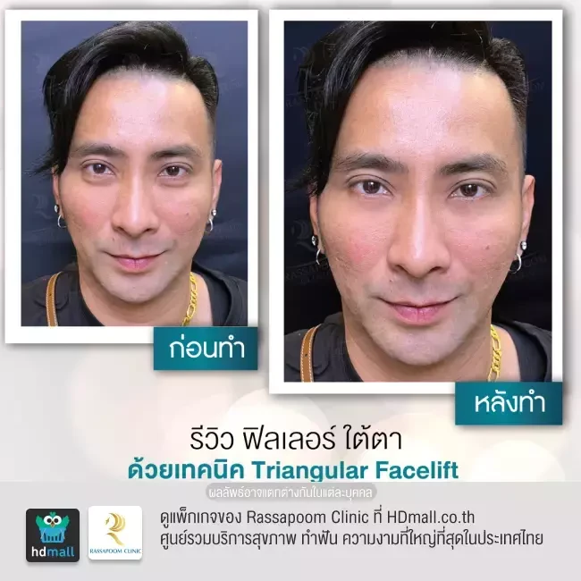 รีวิว Triangular Facelift ที่ Rassapoom Clinic (รัสมิ์ภูมิคลินิก) รูป 1