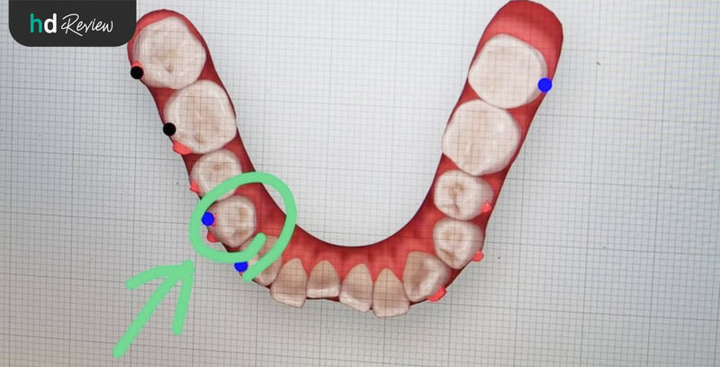 ภาพอธิบายการจัดฟันแบบ Invisalign ที่ Deezy Dental Home