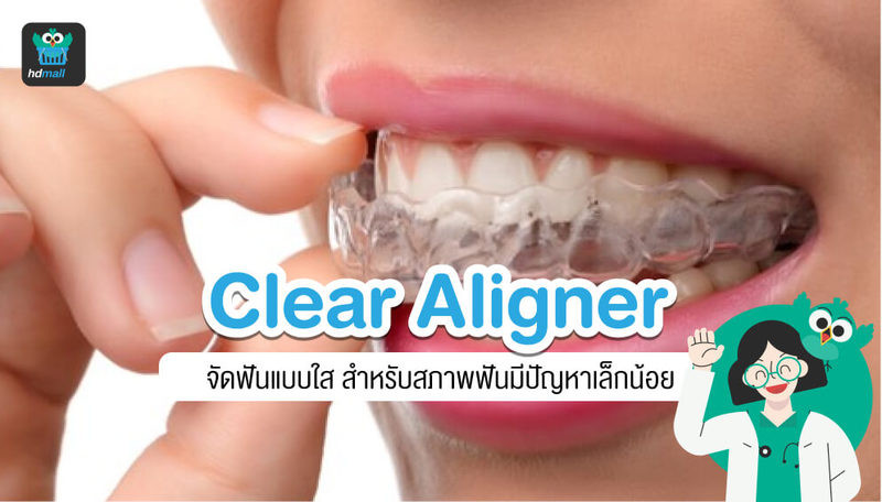 จัดฟันใส Clear Aligner คืออะไร? ราคาเท่าไหร่? ที่ไหนดี?