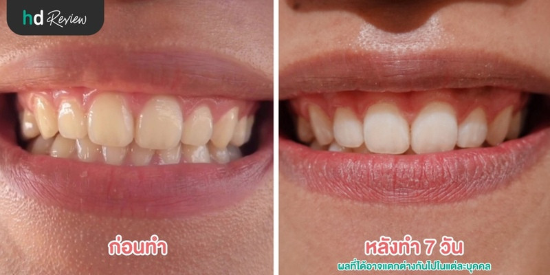 Before after ฟอกฟันขาวที่ Let's Smile Dental Clinic
