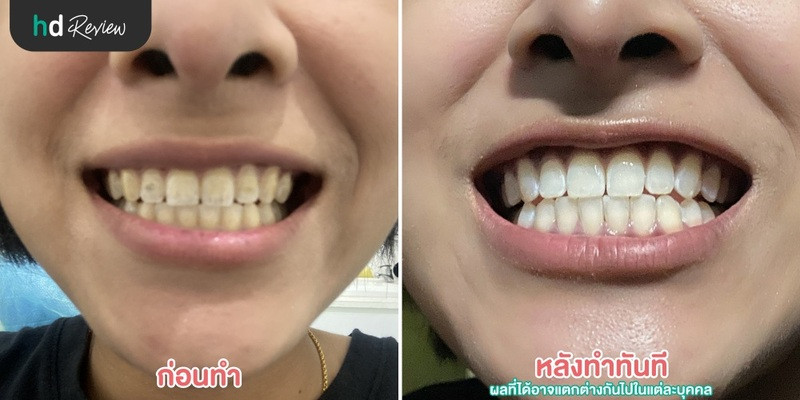 รีวิว ฟอกสีฟัน ด้วยระบบ Cool Light พร้อมขูดหินปูน ที่ NextStep Dental