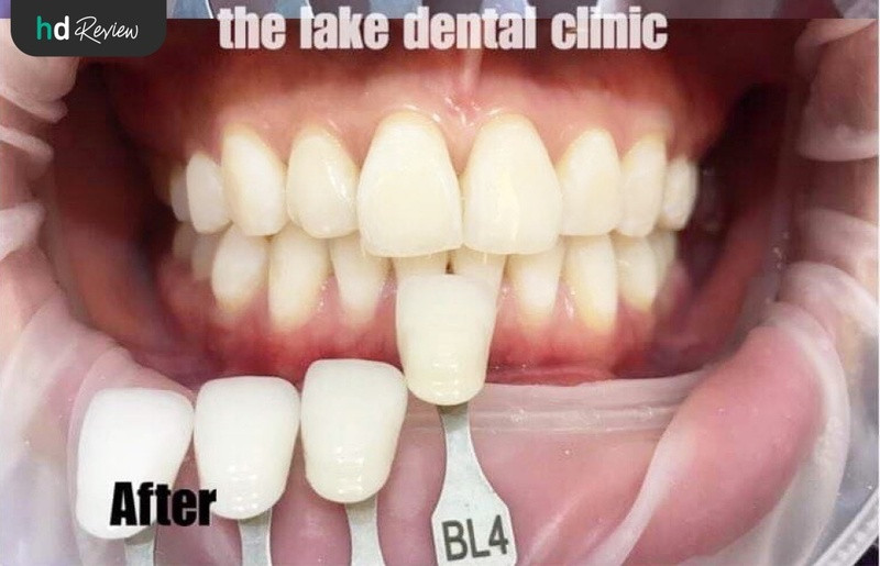 รีวิว ฟอกสีฟันแบบ Cool Light และชุดฟอกสีฟันที่บ้าน ที่ The Lake Dental Clinic