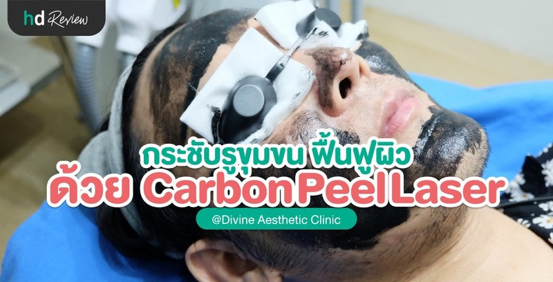 กระชับรูขุมขน ฟื้นฟูผิว ด้วย Carbon Peel Laser ที่ Divine Aesthetic Clinic