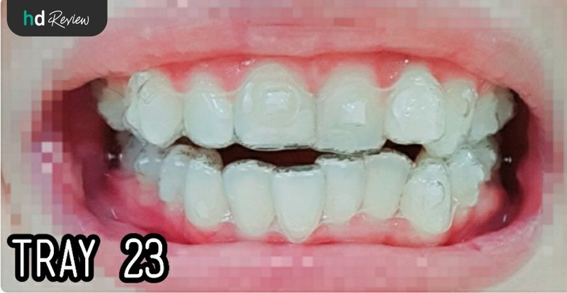 ใส่ชิ้นงานจัดฟันแบบใส Invisalign Full ทั้งฟันบนและฟันล่าง