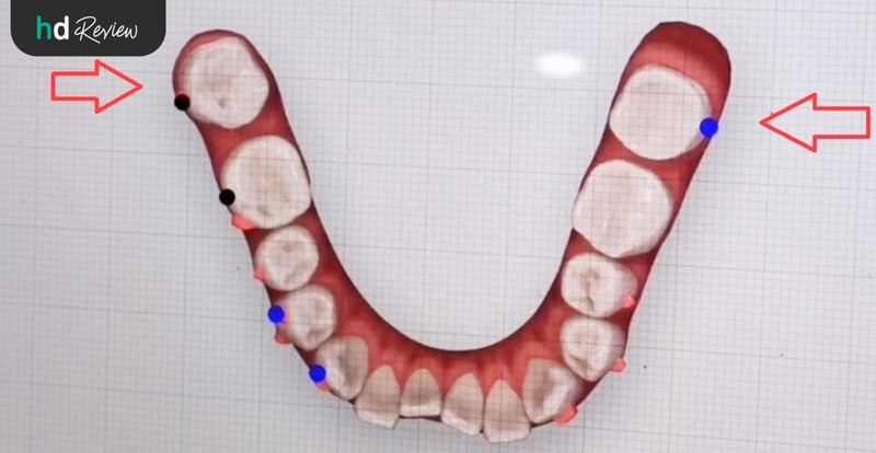 ภาพ 3D อธิบายการทำ Invisalign ที่ Deezy Dental Home