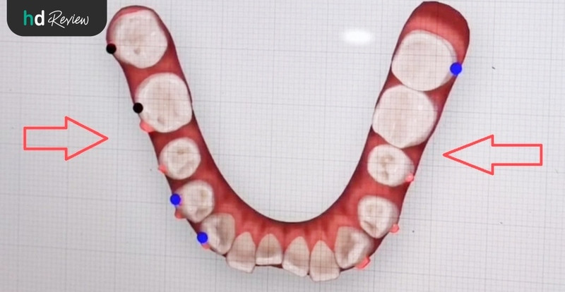 ภาพ 3D อธิบายการทำ Invisalign ที่ Deezy Dental Home