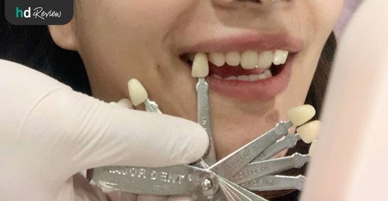 รีวิวฟอกสีฟัน ขูดหินปูนและขัดฟัน ที่ ศูนย์จัดฟัน รากเทียม บูทีคเด็นทัล