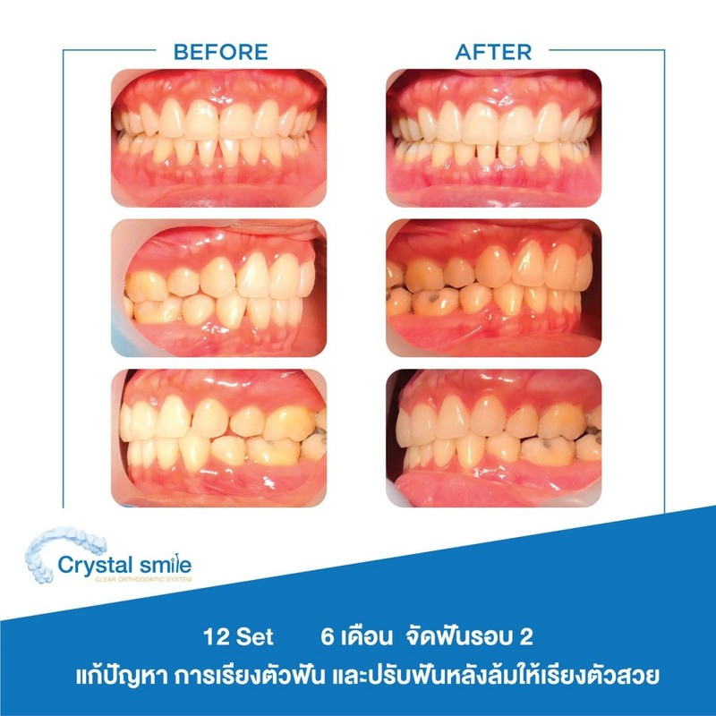 รวมรูปรีวิว จัดฟันใส Crystal Smile ที่ Bangkok Smile Dental