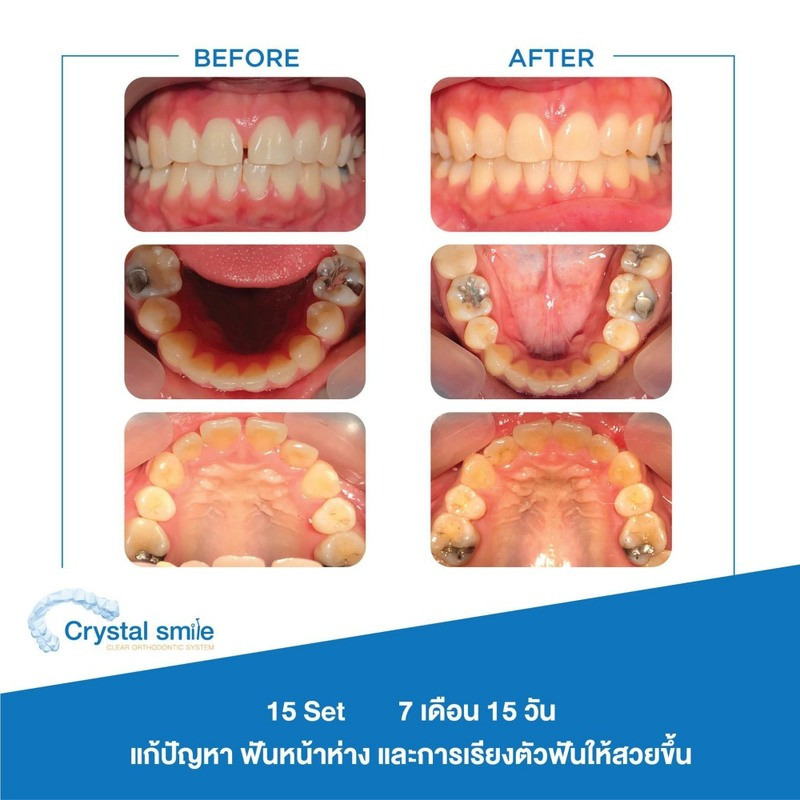 รวมรูปรีวิว จัดฟันใส Crystal Smile ที่ Bangkok Smile Dental