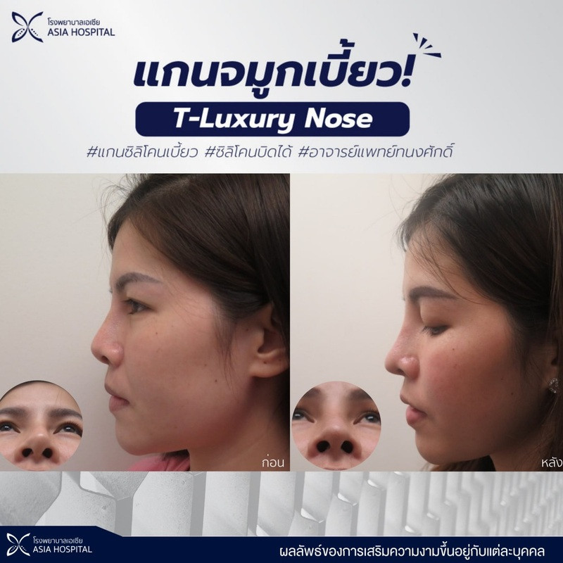 รีวิว แก้จมูก ด้วยเทคนิค T-luxury Nose ที่ โรงพยาบาลเอเซีย