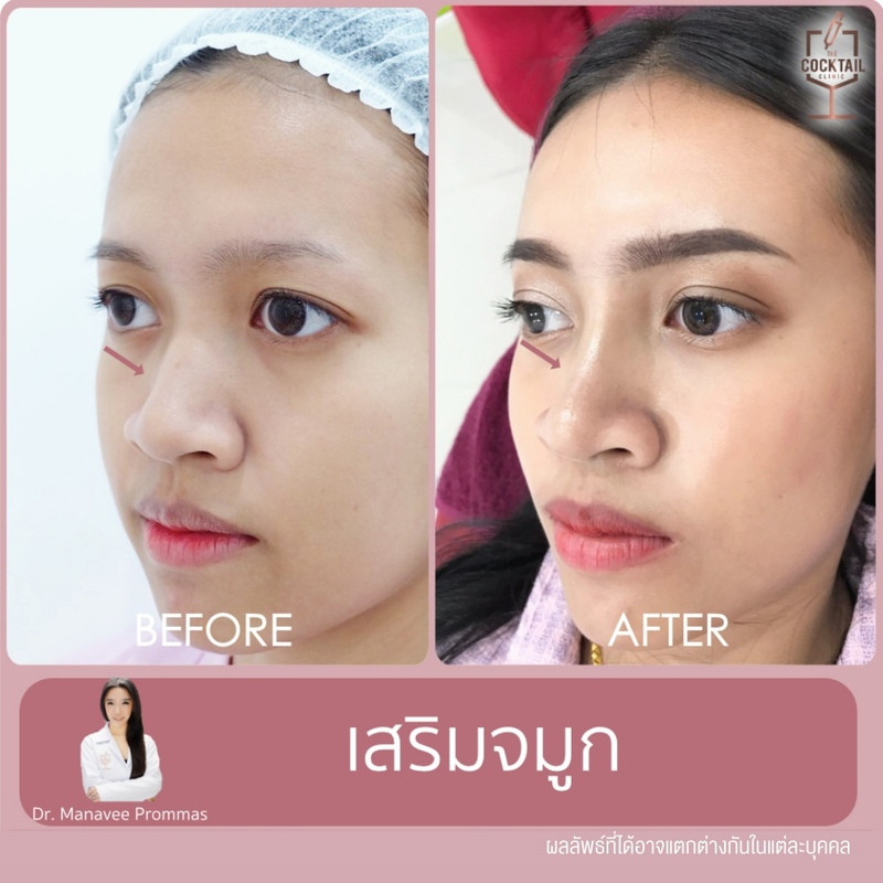 รีวิวศัลยกรรมจมูก ที่ The Cocktail Clinic