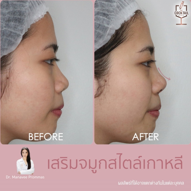 รีวิวศัลยกรรมจมูก ที่ The Cocktail Clinic