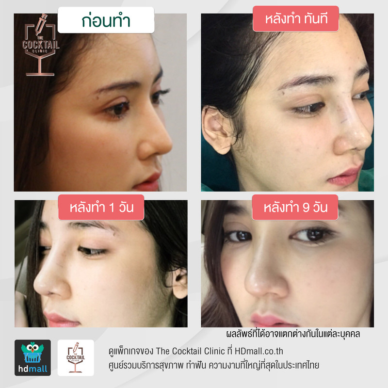 รีวิวศัลยกรรมจมูก ที่ The Cocktail Clinic