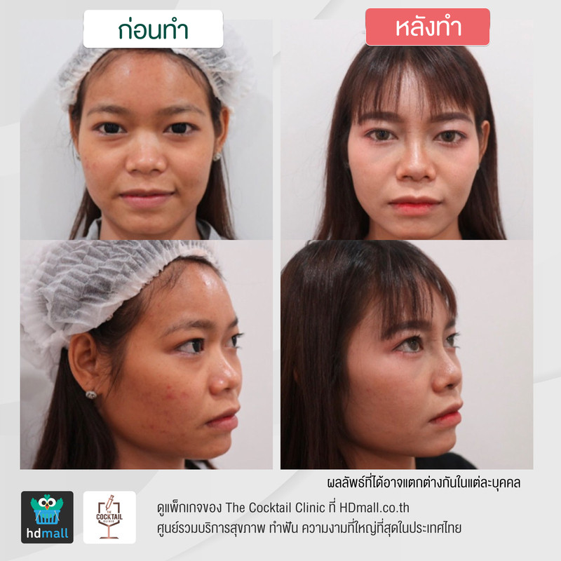 รีวิวศัลยกรรมจมูก ที่ The Cocktail Clinic