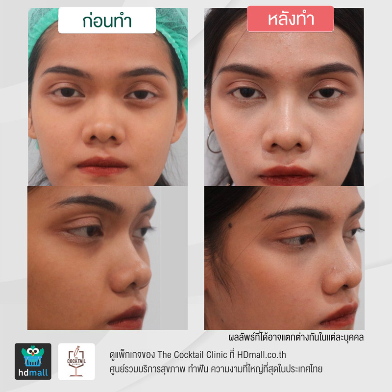 รีวิวศัลยกรรมจมูก ที่ The Cocktail Clinic