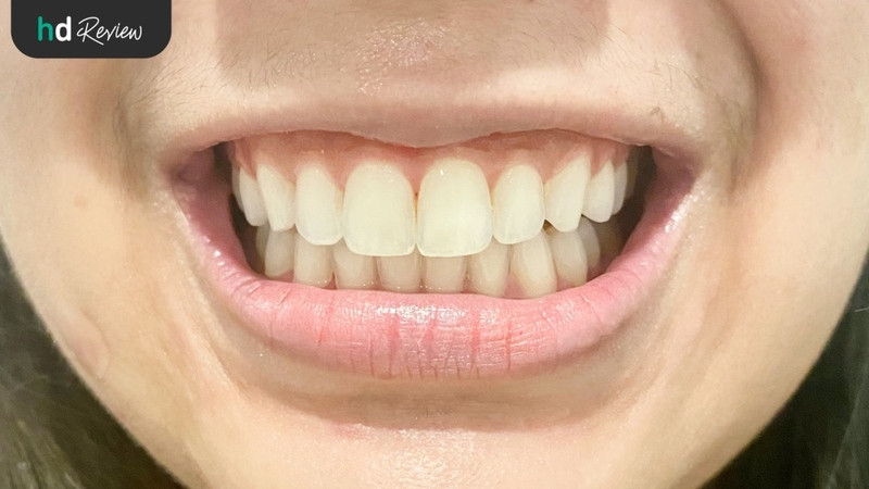 หลังจัดฟันแบบใส Zenyum ที่ Dr.Pisut Dental Clinic ครบ 1 ปี
