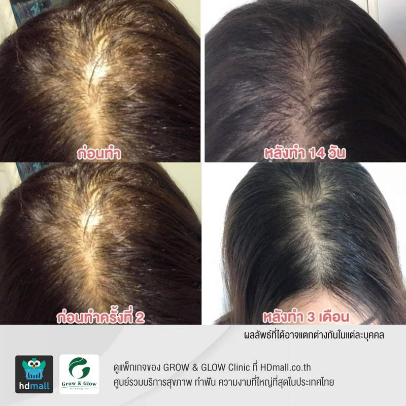 รีวิว Meso Growth Hair ที่ GROW & GLOW Clinic