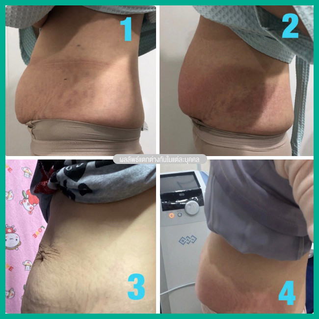 รีวิว ลดหน้าท้องหลังคลอด ด้วยเครื่อง Exilis Ultra Femme 360 องศา ที่ Dr. Aomthong Clinic