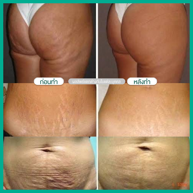 รีวิว ลดหน้าท้องหลังคลอด ด้วยเครื่อง Exilis Ultra Femme 360 องศา ที่ Dr. Aomthong Clinic