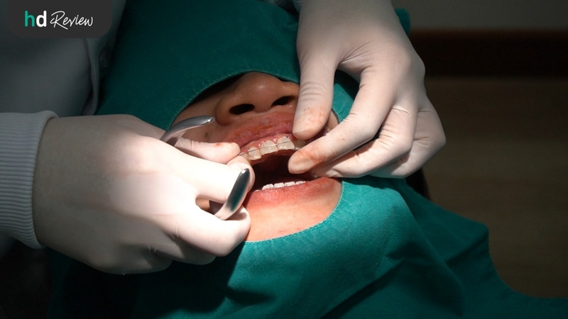 รีวิว จัดฟันแบบเซรามิก ที่ Grace Dental Clinic