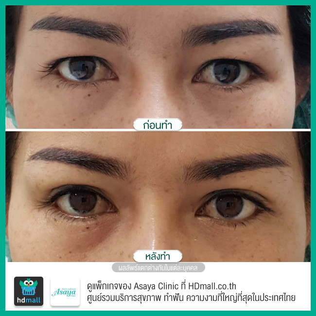 รีวิว ทำตาสองชั้น ที่ Asaya Clinic (อาศยาคลินิก)