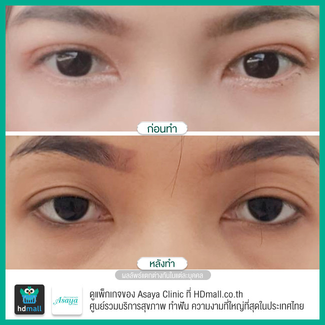 รีวิว ทำตาสองชั้น ที่ Asaya Clinic (อาศยาคลินิก)