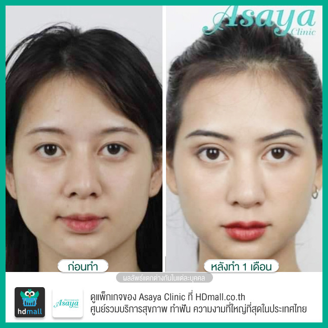 รีวิว ทำตาสองชั้น ที่ Asaya Clinic (อาศยาคลินิก)