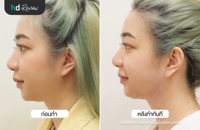 รีวิว NeckTite ดูดไขมันเหนียงและกรอบหน้า ที่ HERS Clinic